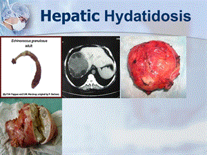 肝包虫英文.ppt