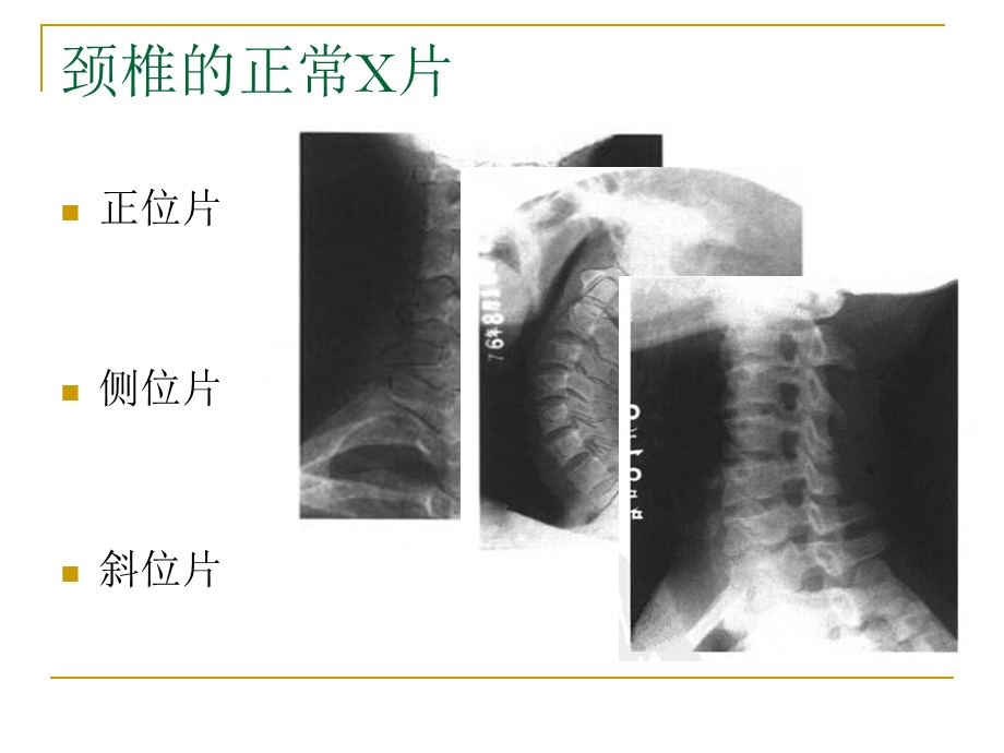 脊柱x片诊断.ppt_第3页