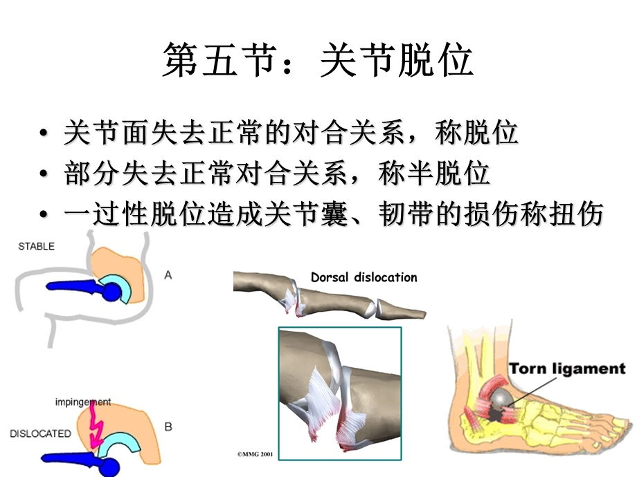 第五节关节脱位.ppt_第1页