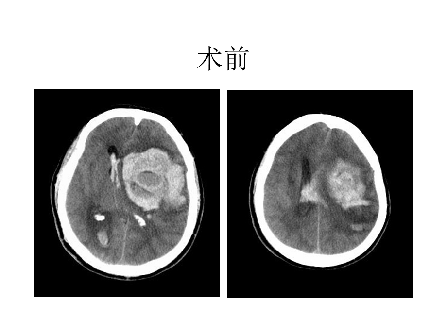 脑外科教学查房.ppt_第2页