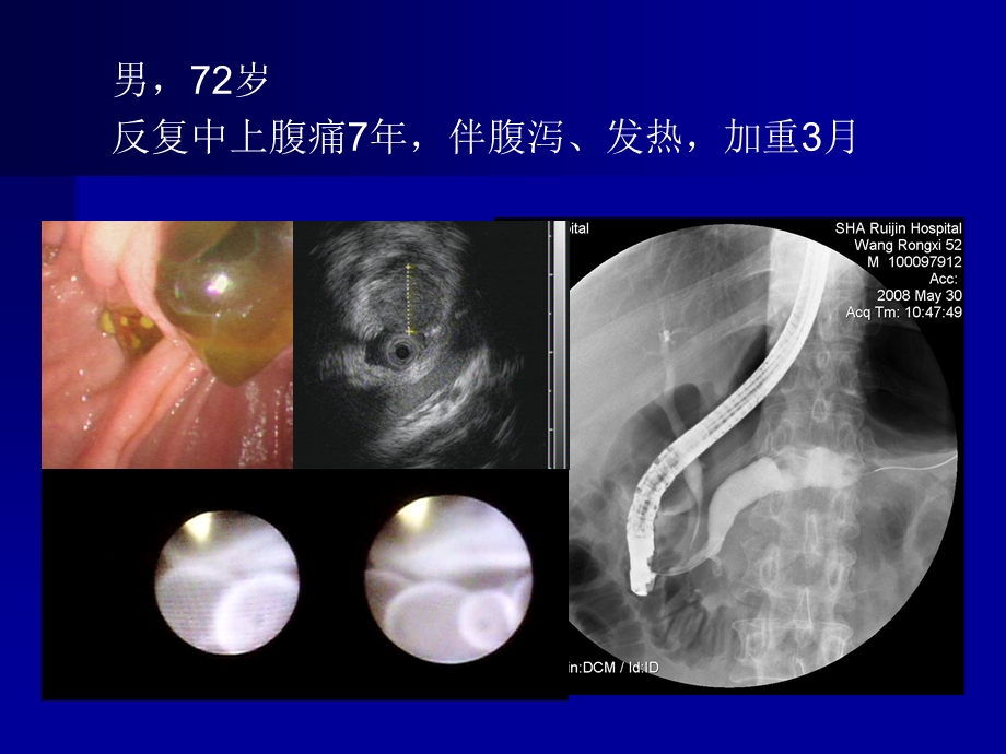 胰腺囊性肿瘤的影像细胞和分子学诊断.ppt_第3页