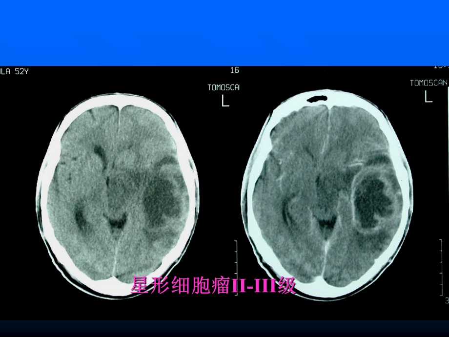 脑部疾病诊断1.ppt_第2页