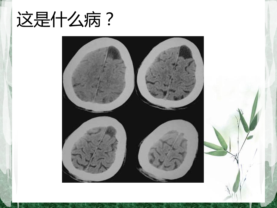 蛛网膜囊肿2.ppt_第3页