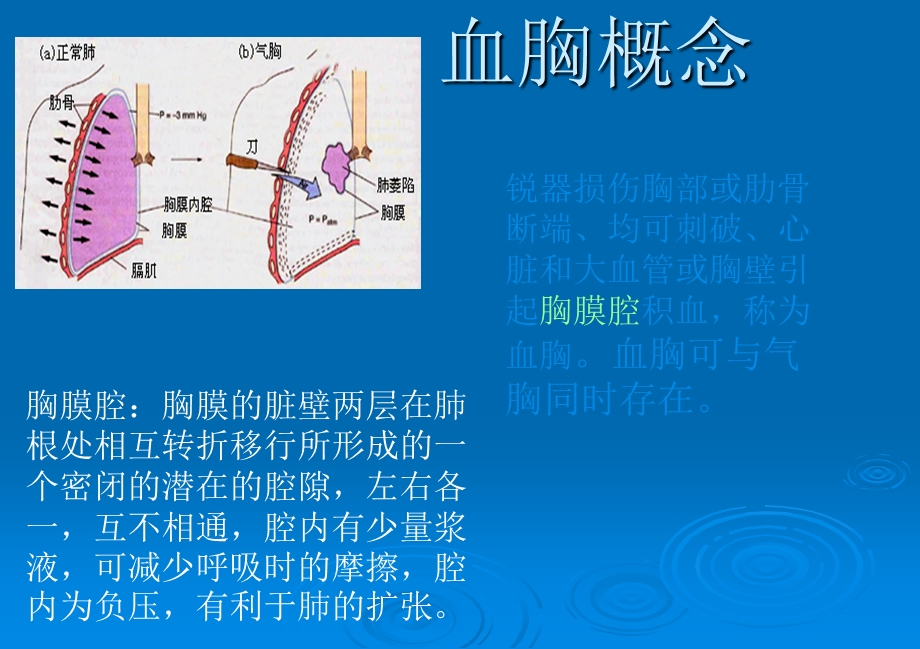 血胸护理ppt课件.ppt_第2页