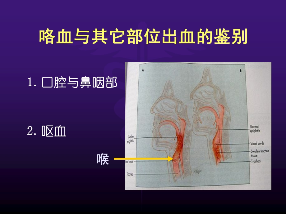 诊断学咯血.ppt_第3页