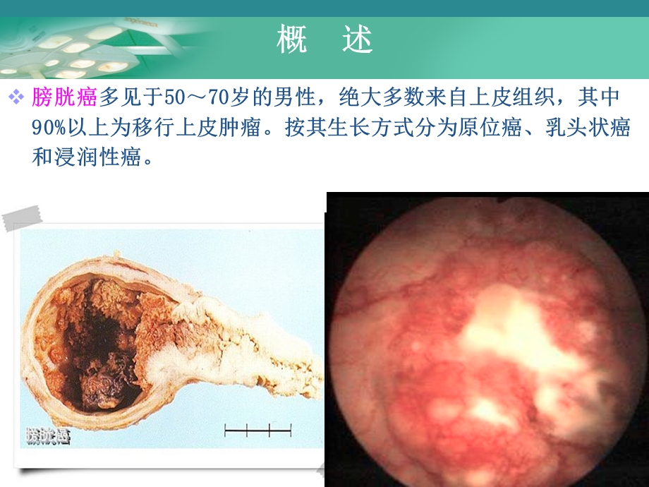 膀胱肿瘤病人的护理.ppt_第3页