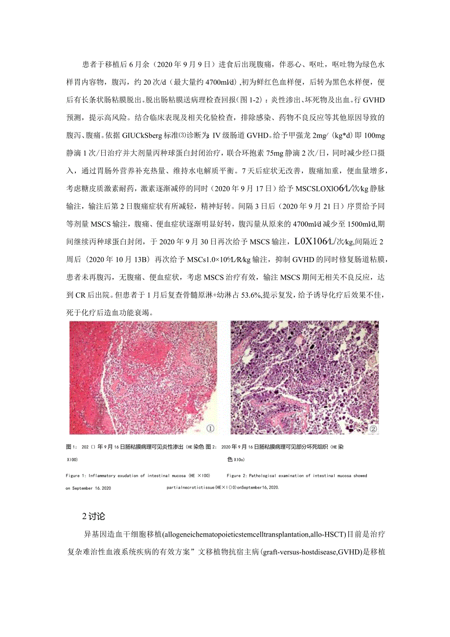 间充质干细胞治疗单倍体造血干细胞移植后胃肠道重度GVHD1例并文献复习.docx_第3页