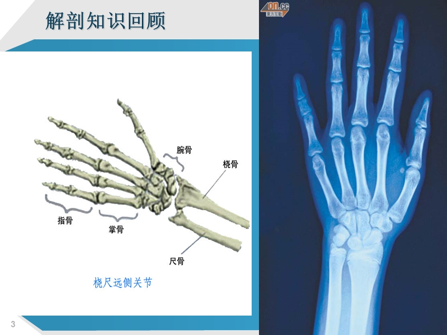 多指畸形.ppt_第3页