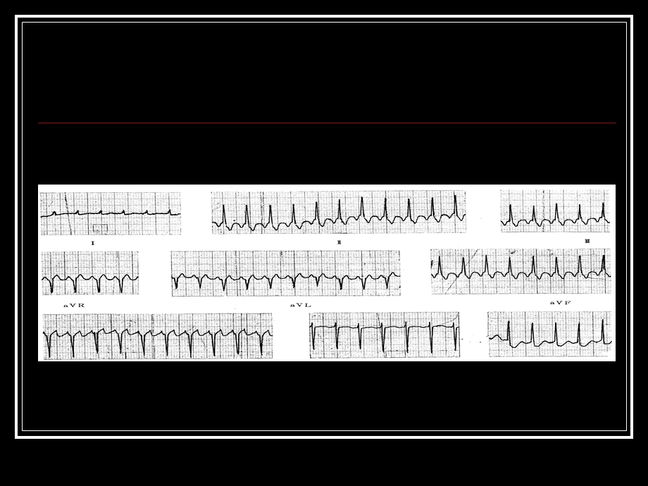 心房纤颤巡诊.ppt_第3页