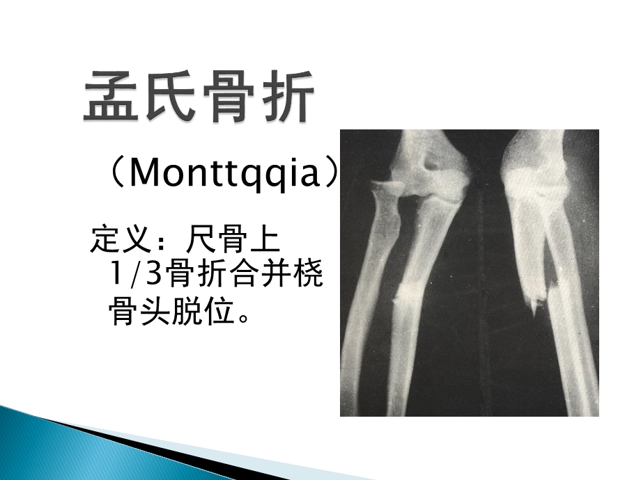 孟氏骨折与盖氏骨折.ppt_第1页