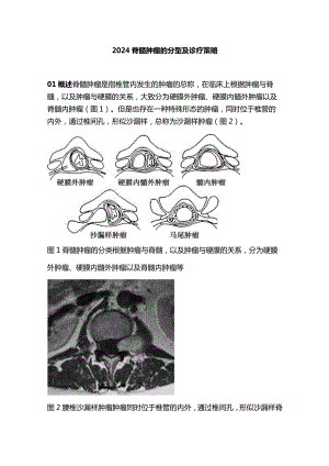 2024脊髓肿瘤的分型及诊疗策略.docx