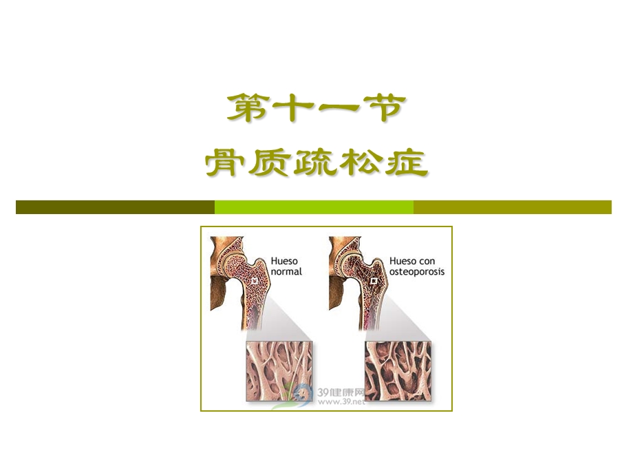 【精品】第十一节 骨质疏松症26.ppt_第1页