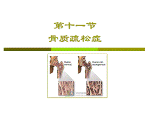 【精品】第十一节 骨质疏松症26.ppt