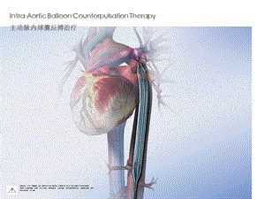 IABP介绍重点.ppt