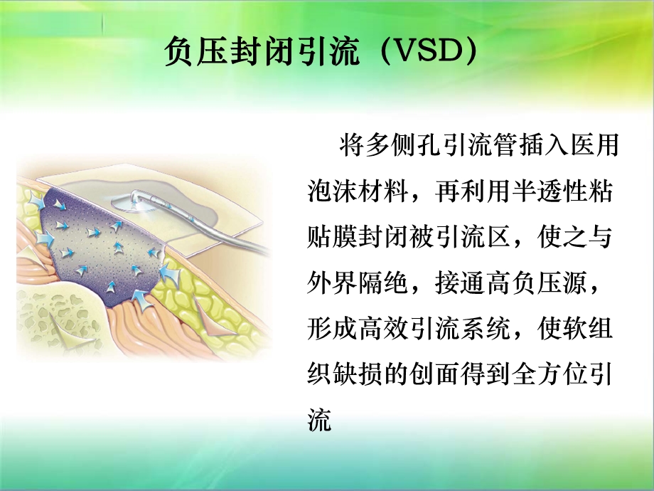 VSD的机制及相关护理.ppt_第2页