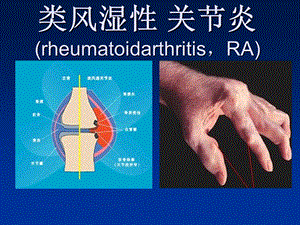 35类风湿性关节炎.ppt