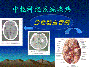 36急性脑血管病(简).ppt