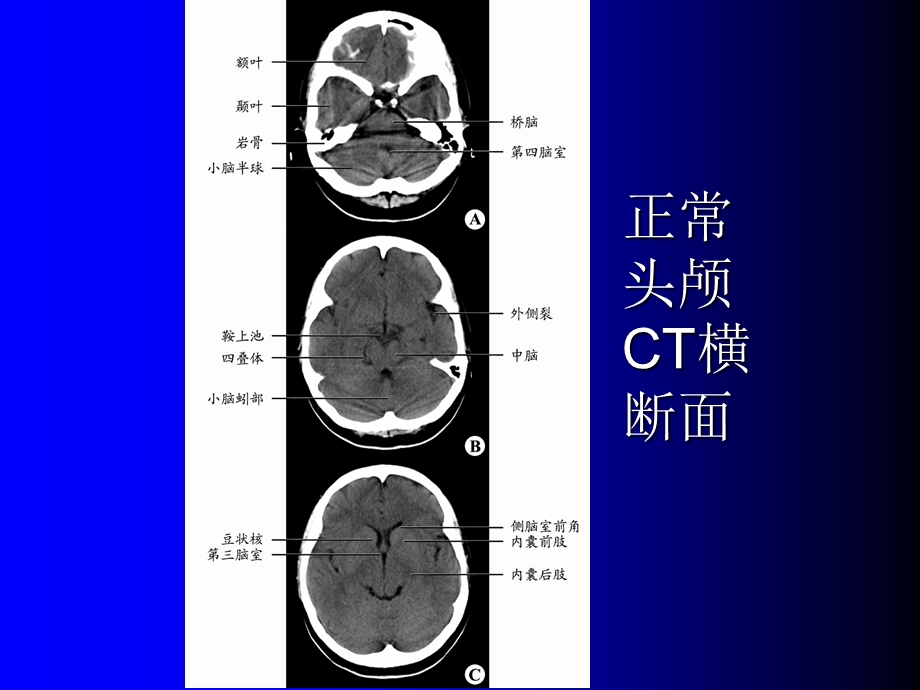 医学影像诊断学—头颈部病例.ppt.ppt_第2页