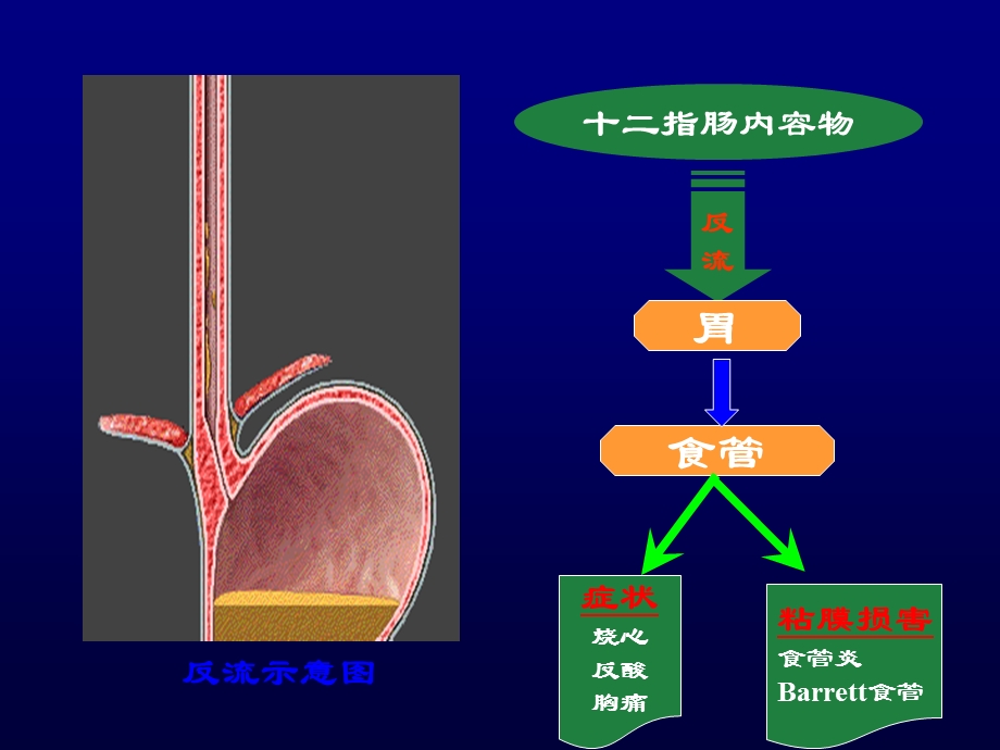 十二指肠胃反流与胆汁反流性疾病[1].ppt_第2页