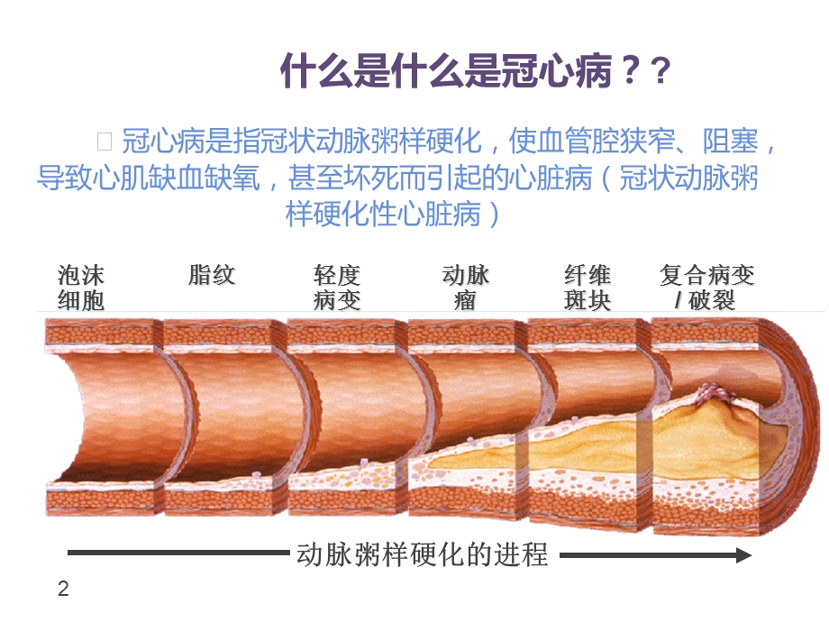 冠心病患者如何改善生活方式.ppt_第2页