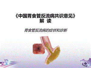 中国胃食管反流病共识意见.ppt