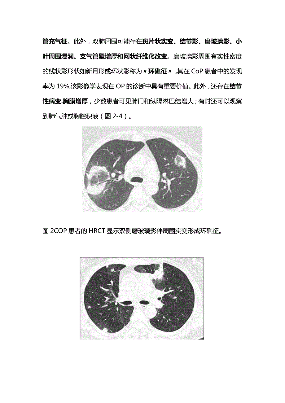 隐源性机化性肺炎的临床特征和诊断要点2024.docx_第3页