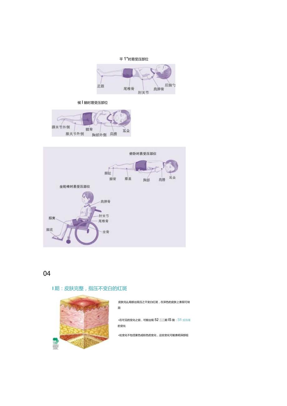 2024压力性损伤的临床分期及措施.docx_第3页