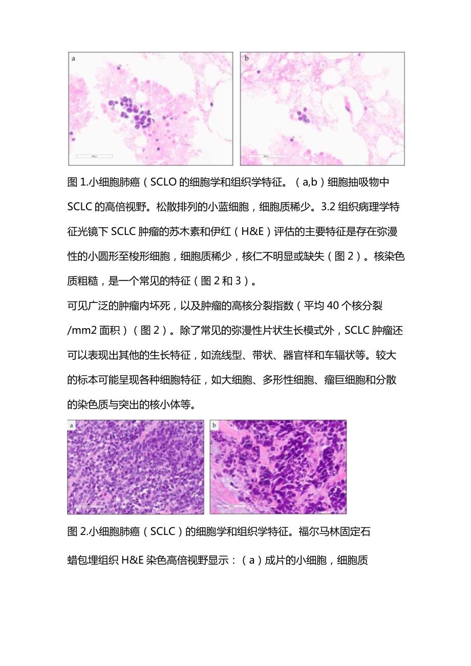 2024小细胞肺癌病理诊断要点.docx_第3页