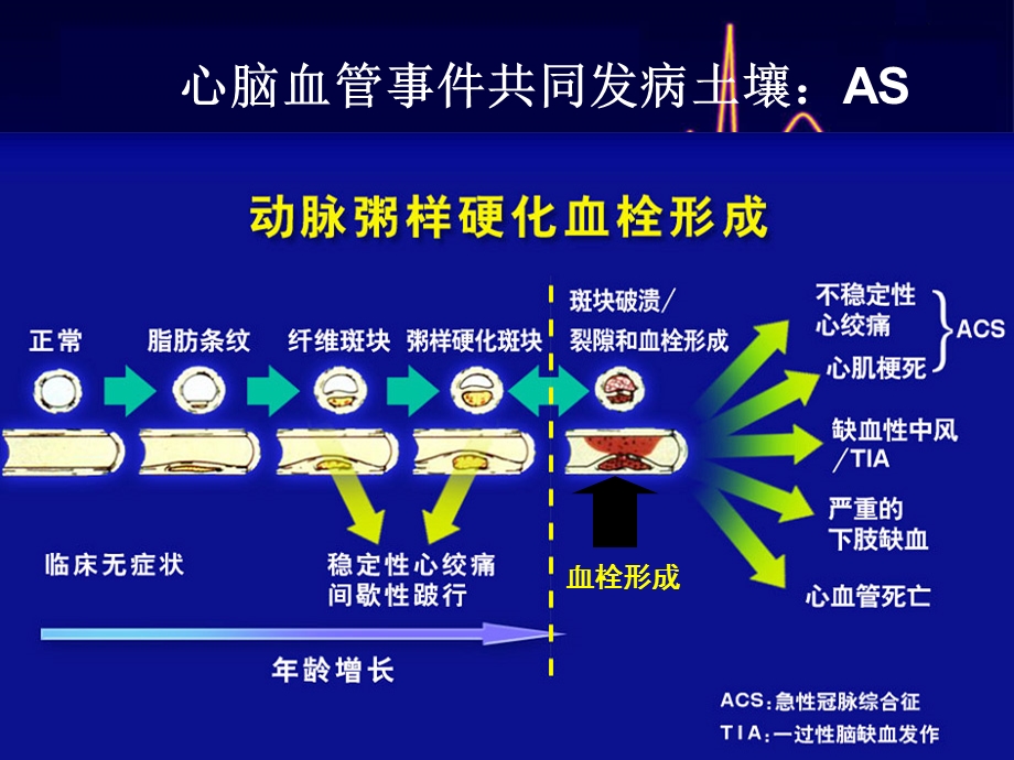 合并脑卒中的急性冠脉综合征患者抗栓治疗.ppt_第3页