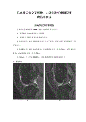 临床膝关节交叉韧带、内外侧副韧带撕裂疾病临床表现.docx