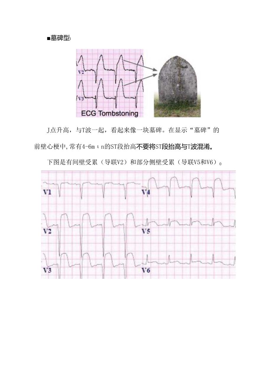 急性心肌梗死正确的诊断和鉴别诊断.docx_第2页