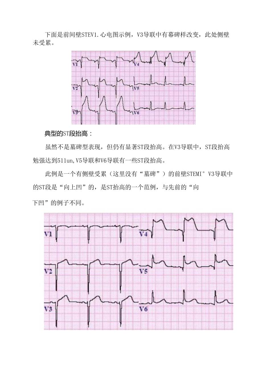 急性心肌梗死正确的诊断和鉴别诊断.docx_第3页