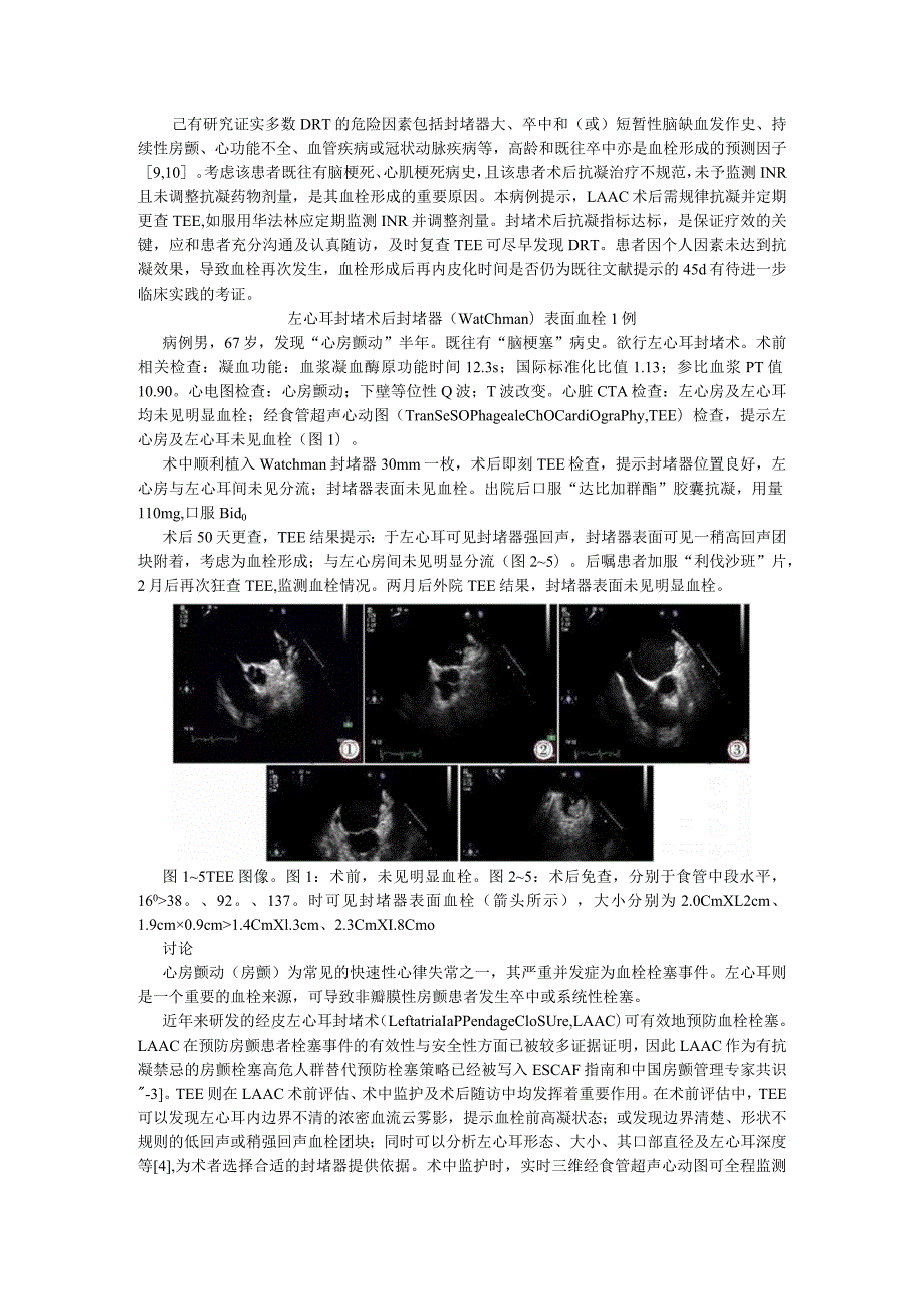 （病例报告）左心耳封堵器血栓两例.docx_第3页