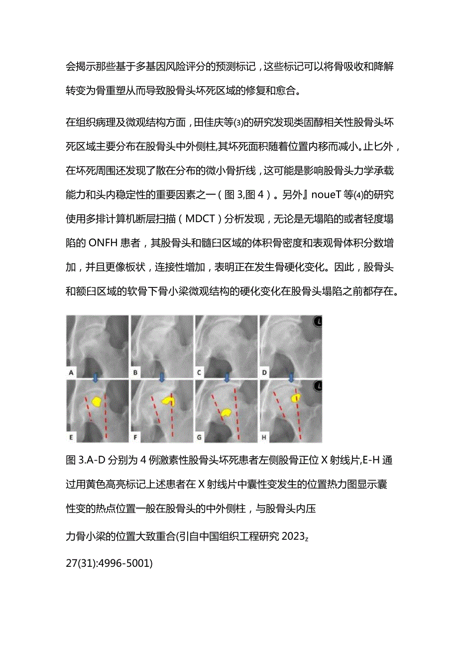 2023股骨头坏死的研究与诊治进展年度报告.docx_第3页