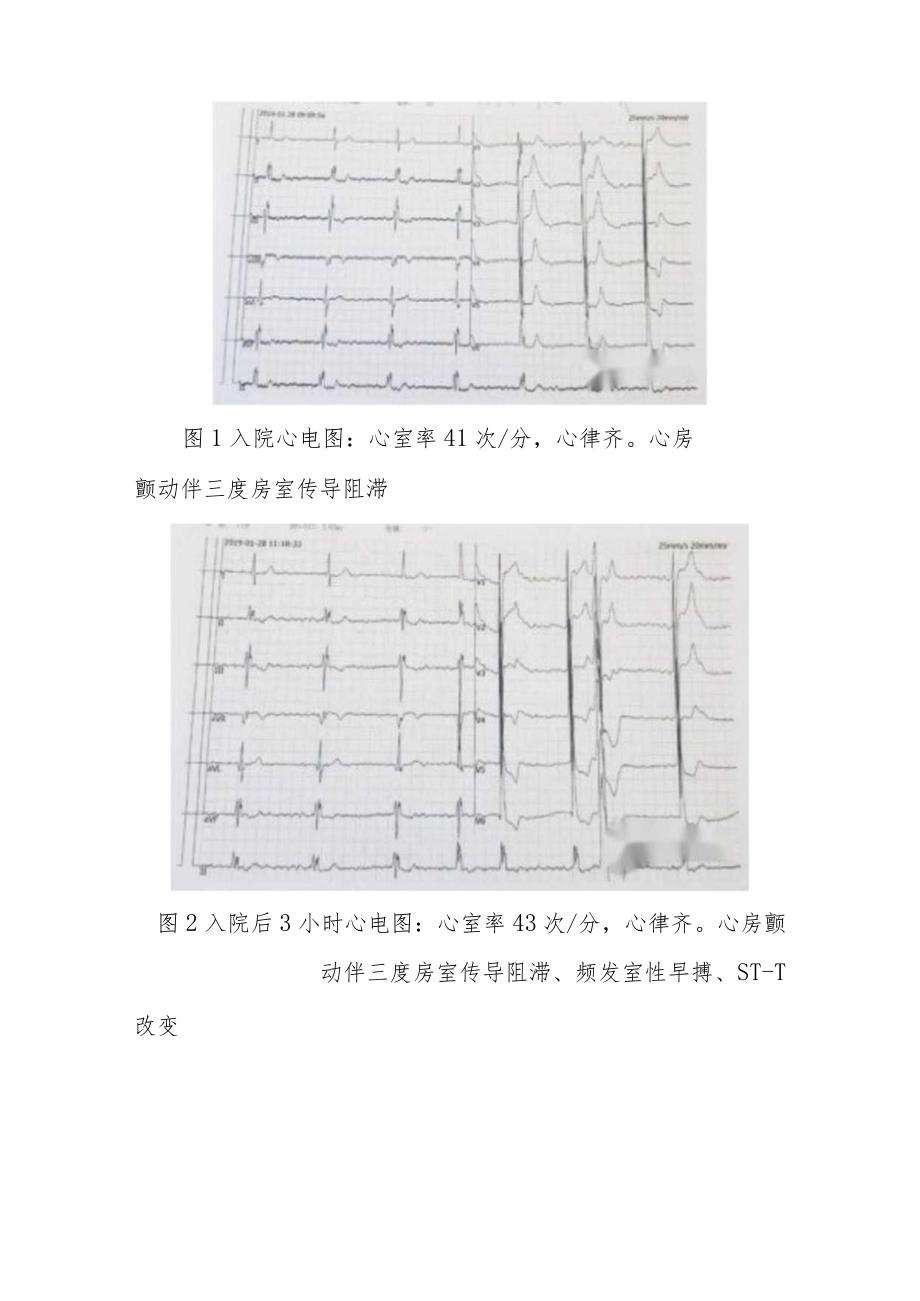 内科地高辛中毒病例分析专题报告.docx_第3页