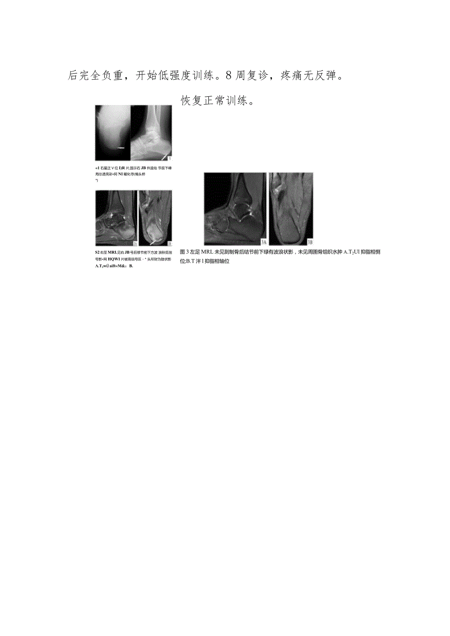 骨科单侧跟骨疲劳骨折病例分析专题报告.docx_第2页