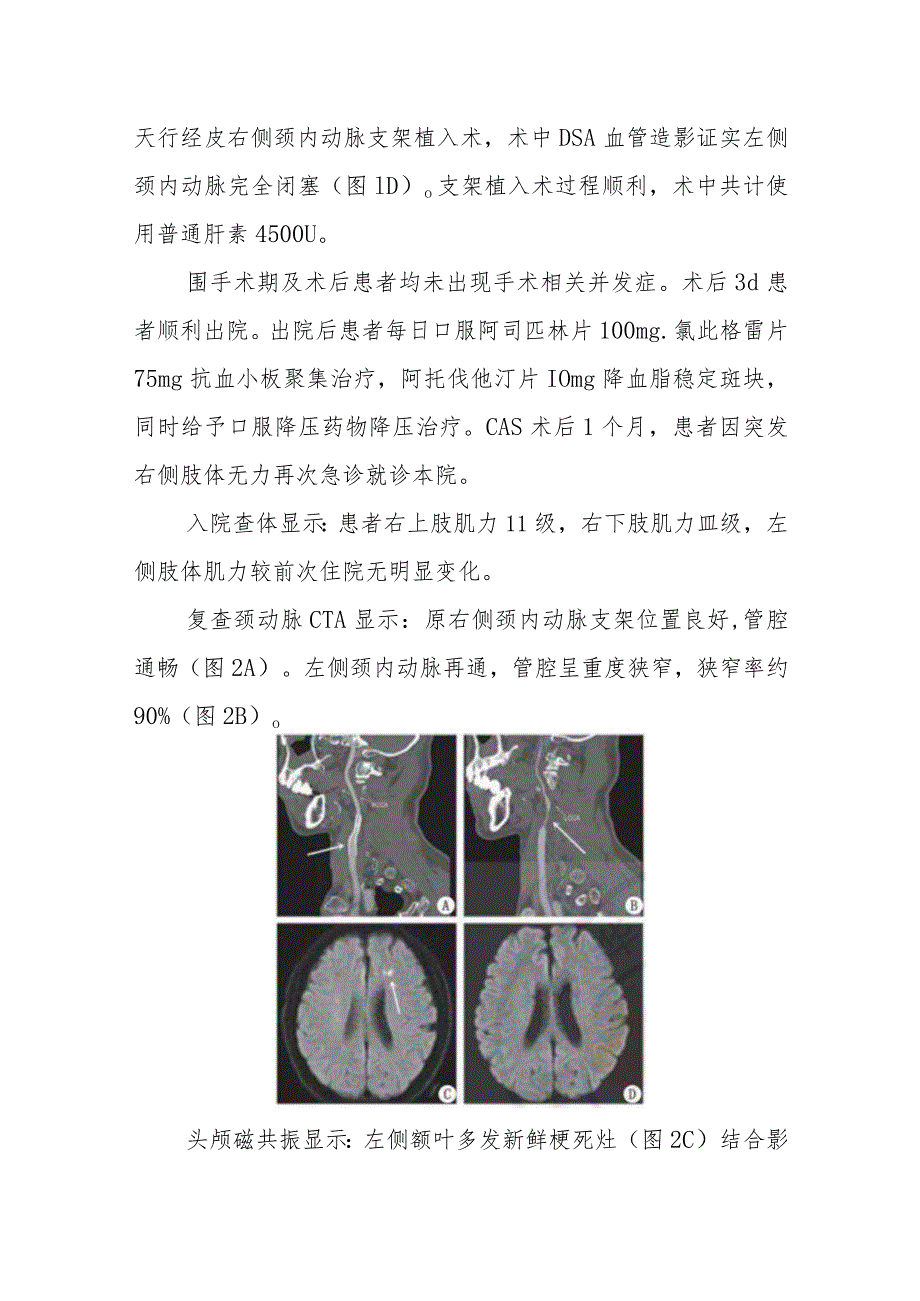 神经内科动脉粥样硬化性颈内动脉闭塞自发性再通致急性脑梗死病例分析专题报告.docx_第2页