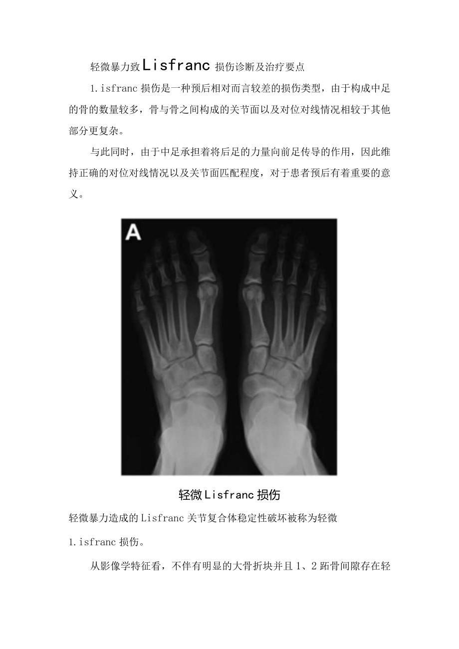 轻微暴力致Lisfranc损伤诊断及治疗要点.docx_第1页