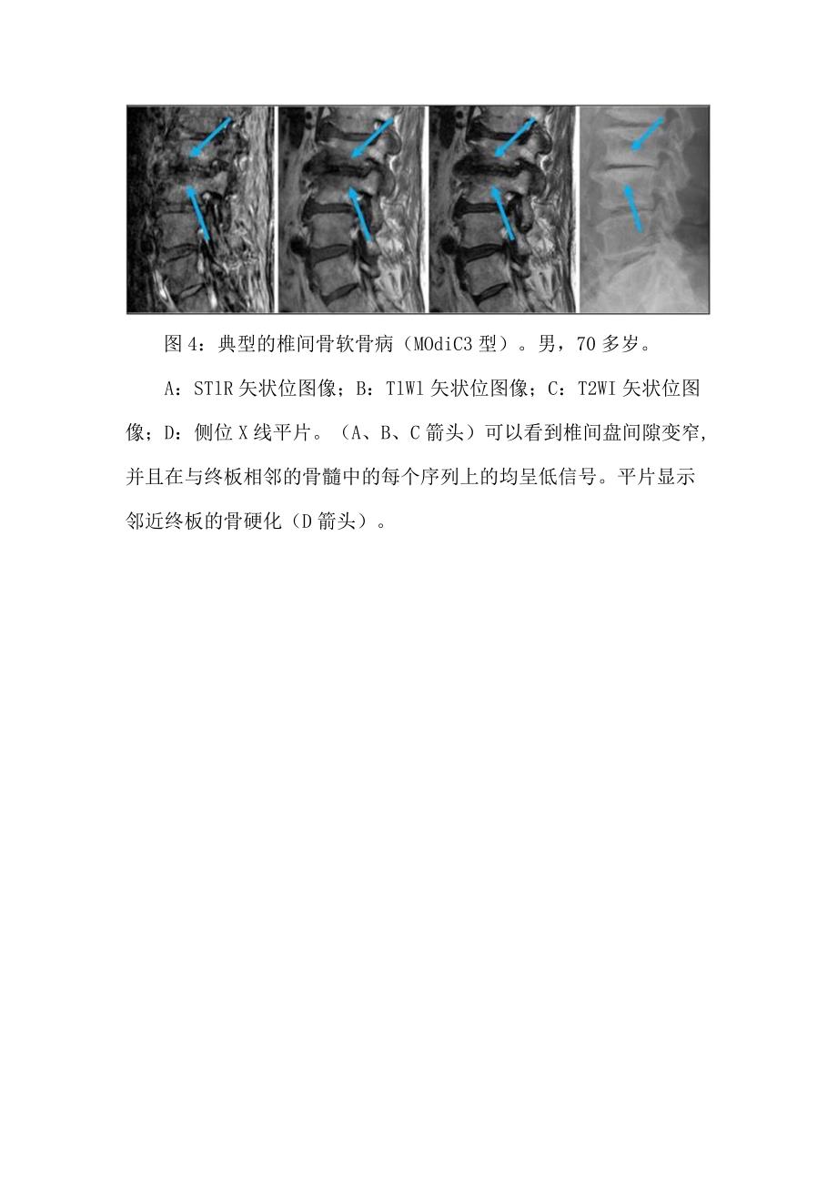 椎间骨软骨病临床表现及影像学表现.docx_第3页