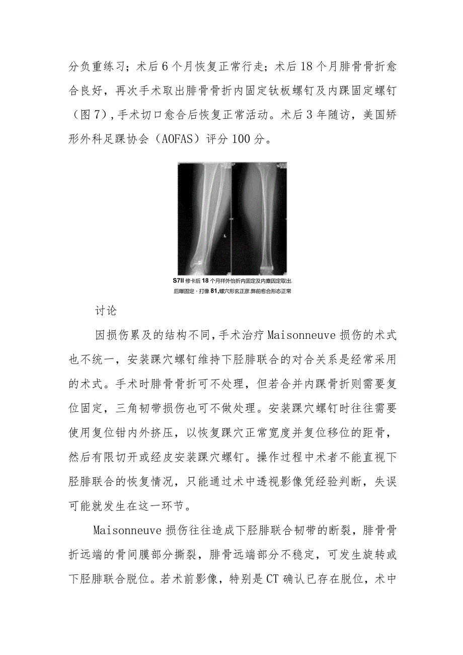 骨科手术治疗Maisonneuve骨折失误病例分析专题报告.docx_第3页