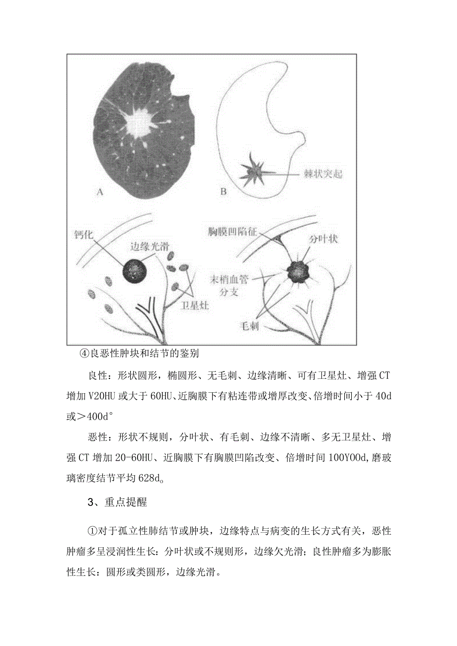 肺内结节肿块与结节临床概述、CT影像表现、重点提醒及临床表现.docx_第2页