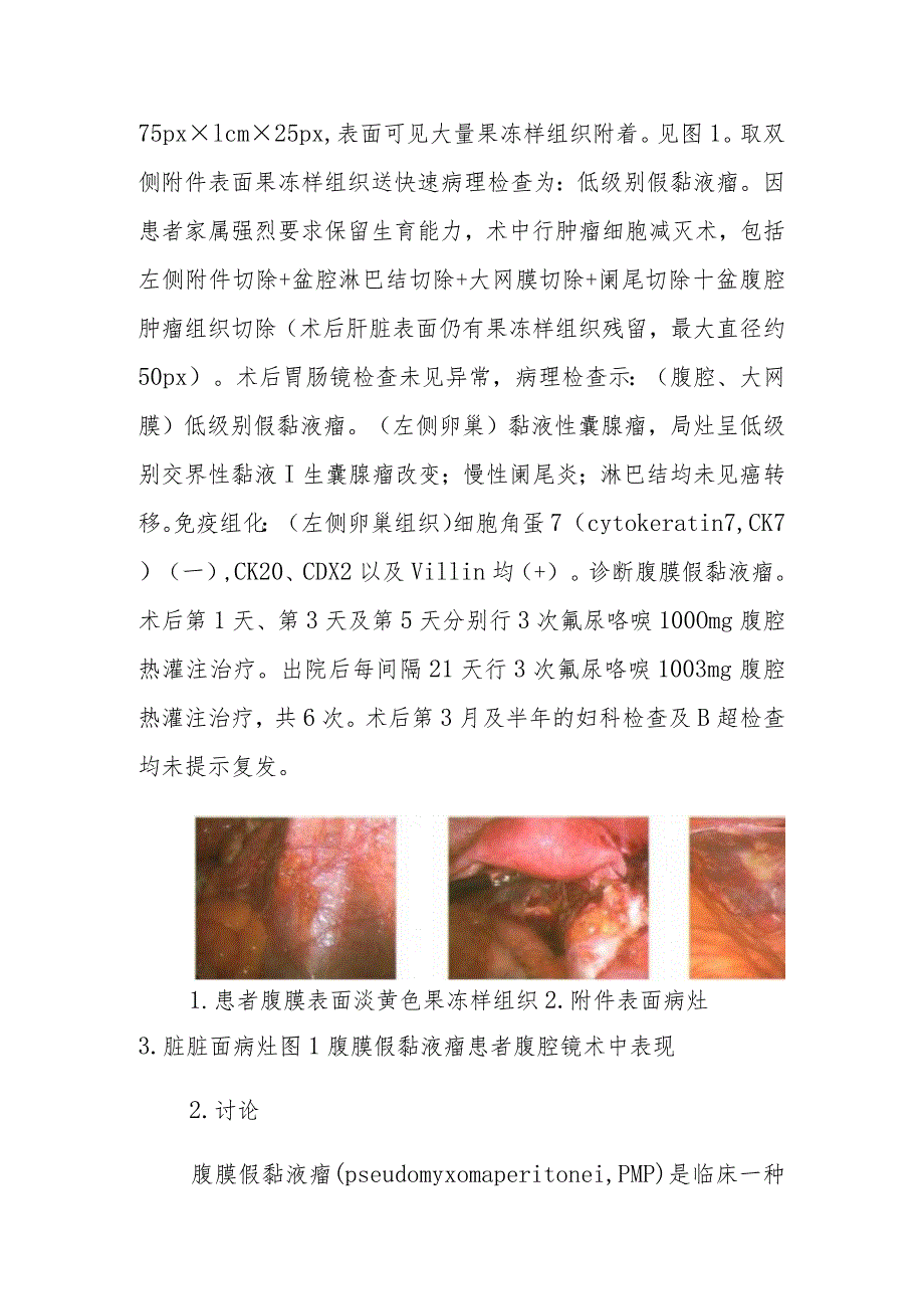 外科腹膜假黏液瘤保留生育病例报告专题分析.docx_第2页