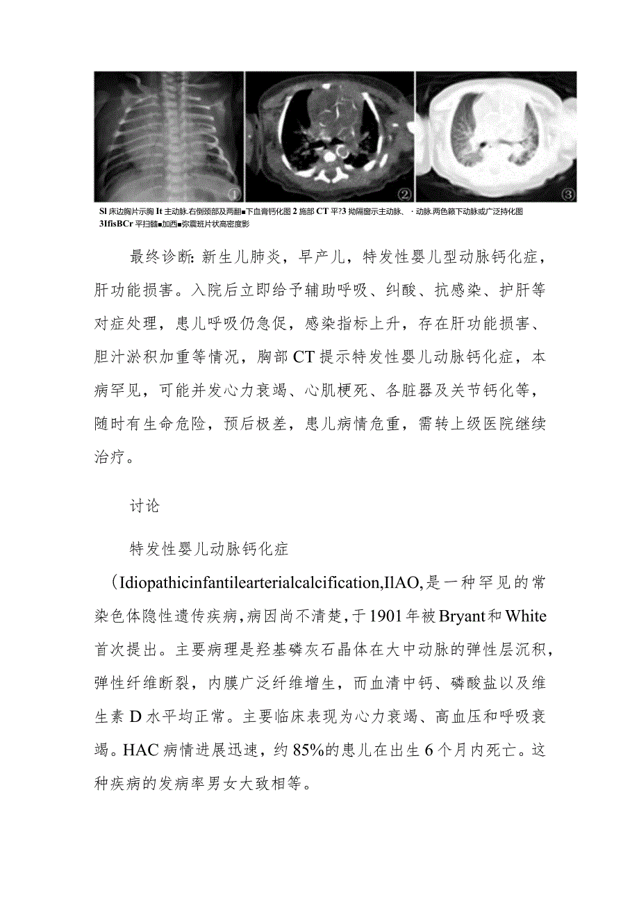 心血管内科特发性婴儿动脉钙化症病例分析专题报告.docx_第2页