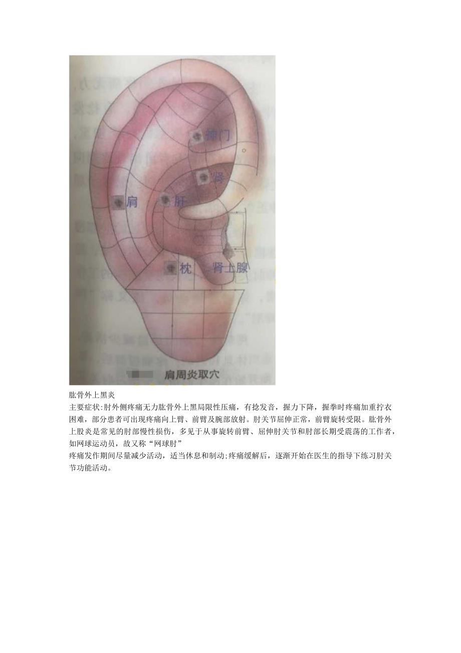 2.20耳穴 落枕 颈椎病 肩周炎 网球肘.docx_第3页