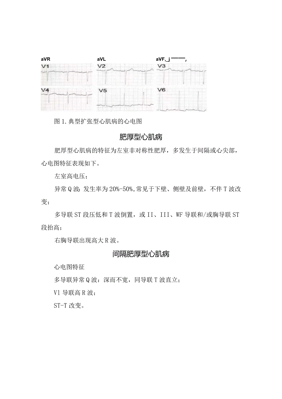 临床扩张型、肥厚性、间隔肥厚性、心尖肥厚型、限制型、致心律失常性右室、继发性、酒精性、 围产期等心肌病心电图特征.docx_第2页