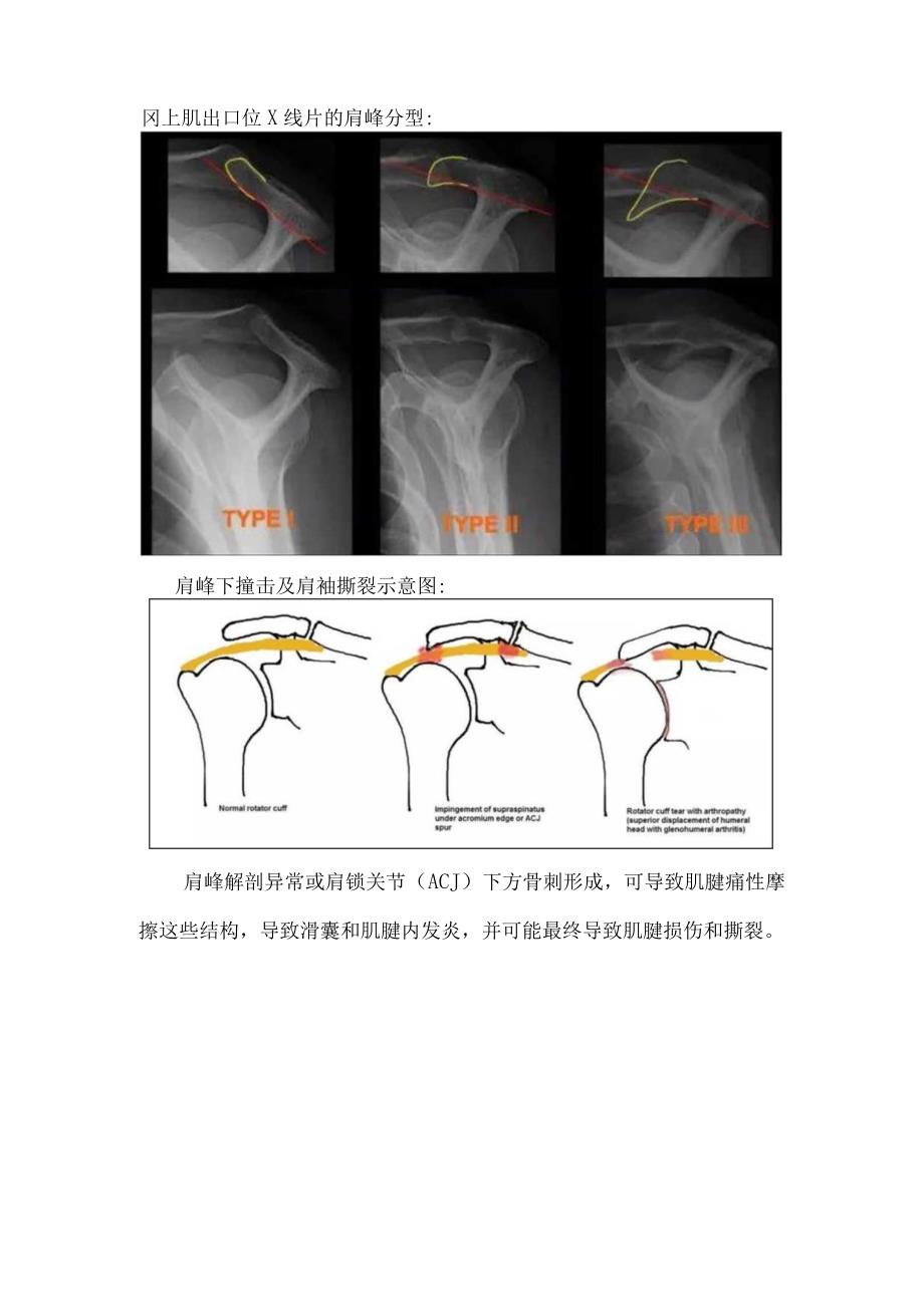 临床肩峰分型及肩峰下撞击及肩袖撕裂影像学表现.docx_第2页