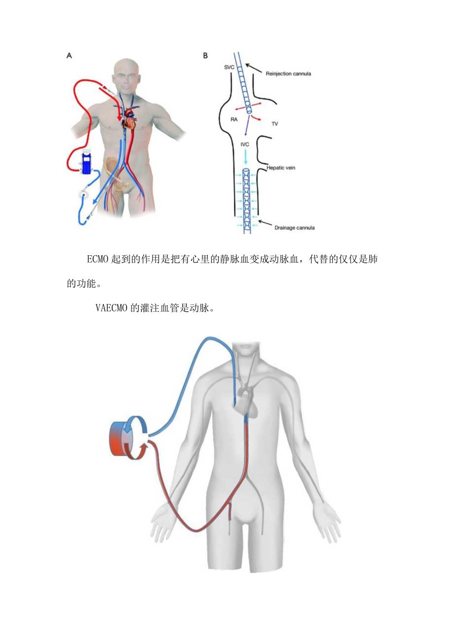 临床ECMO作用、心脏外科术后、体外心肺复苏、爆发性心肌炎、肺移植等治疗适应症、禁忌症、治疗管理及撤机标准.docx_第2页