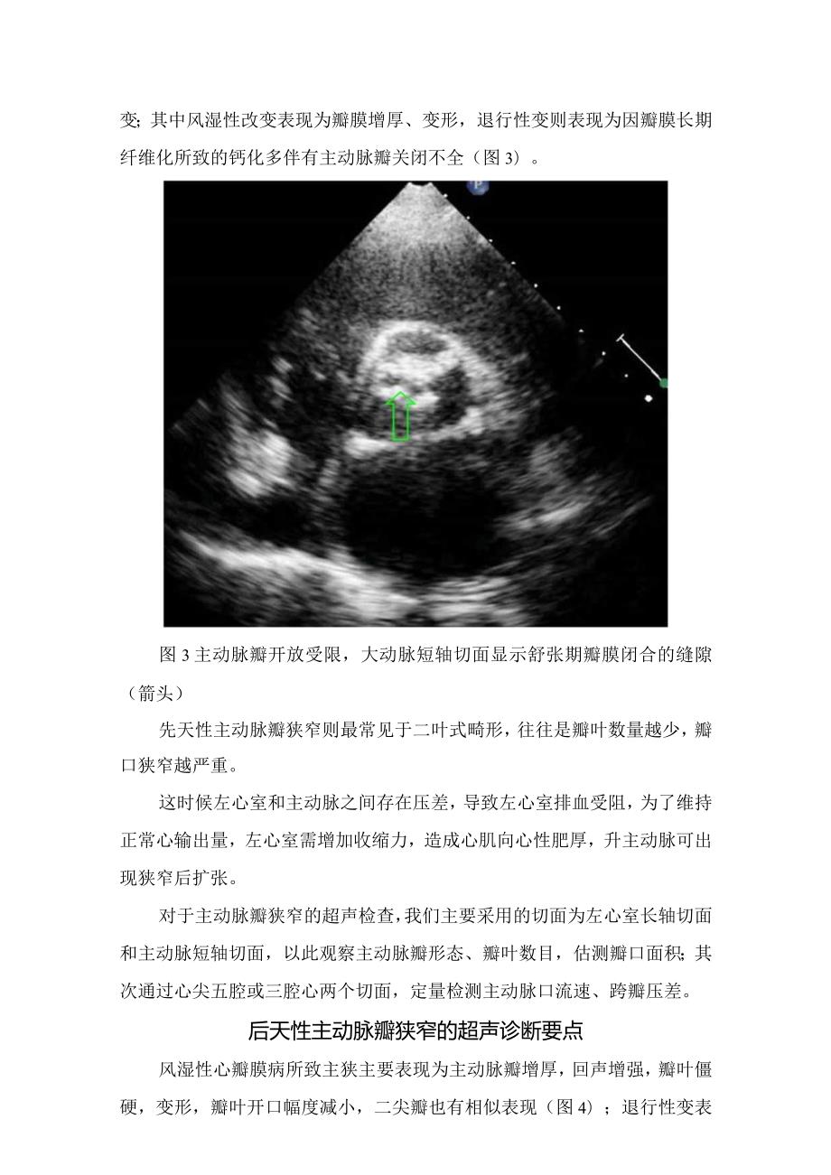 临床主动脉瓣狭窄超声诊断要点.docx_第2页