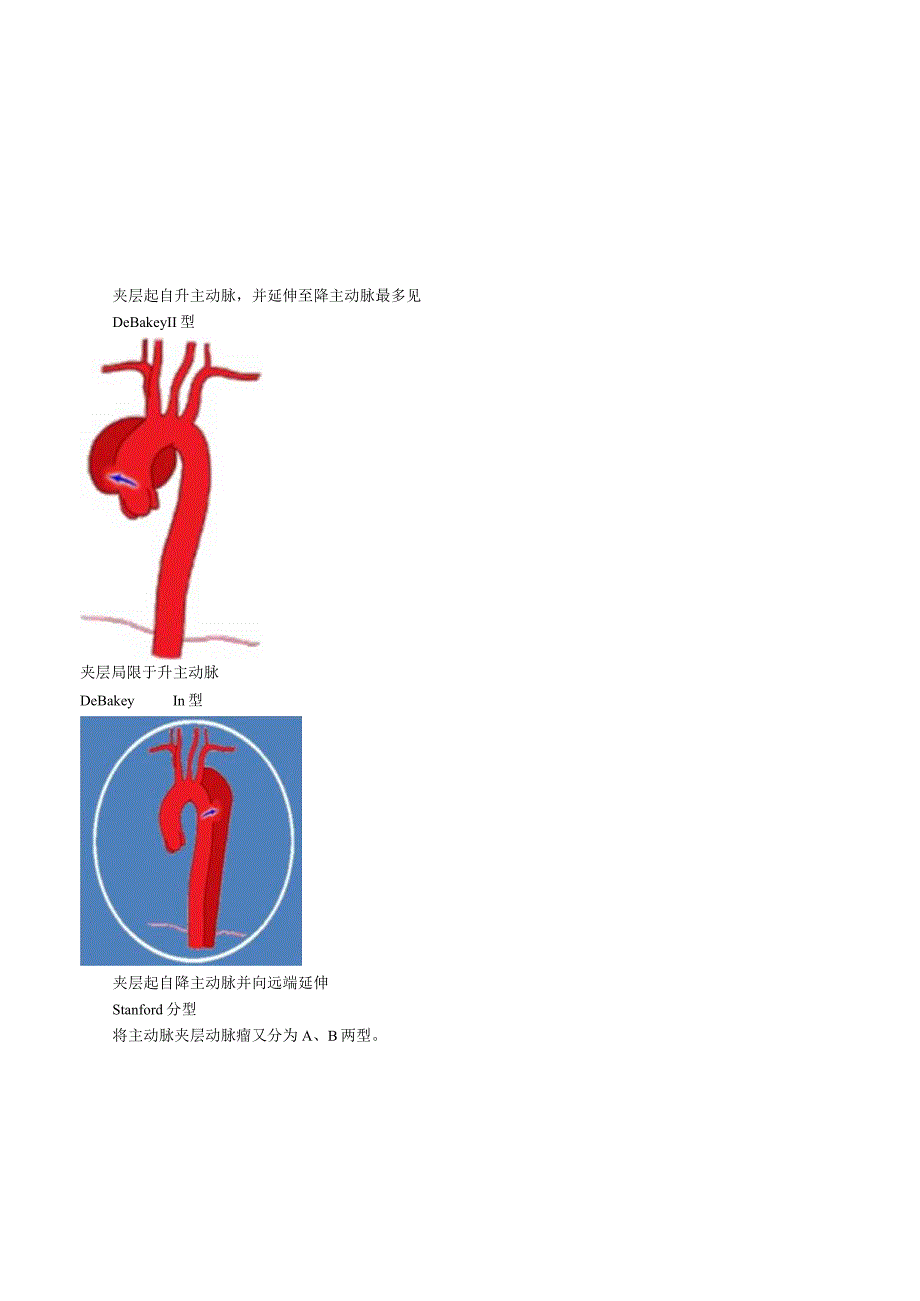 心血管内科主治医师资格笔试专业知识考点解析 (11)：主动脉夹层.docx_第2页