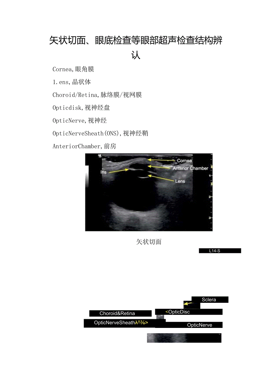 矢状切面、眼底检查等眼部超声检查结构辨认.docx_第1页